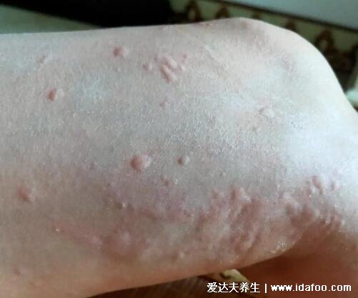 初期荨麻疹图片和症状，身上起红疙瘩很痒的图片(4种类型)