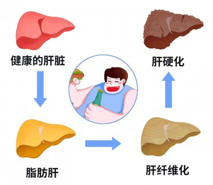 坚持三个护肝秘诀，有效改善肥胖性脂肪肝对身体的危害