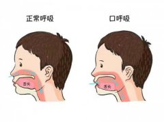 用嘴呼吸影响颜值(口呼吸对颜值的影响