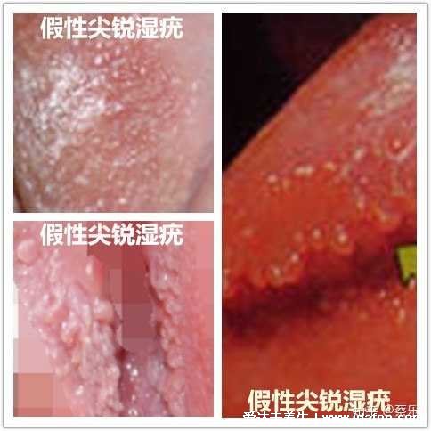 女性假疣和真疣的区别图片，看看尖湿锐尤典型图片(真疣可X接触传染)