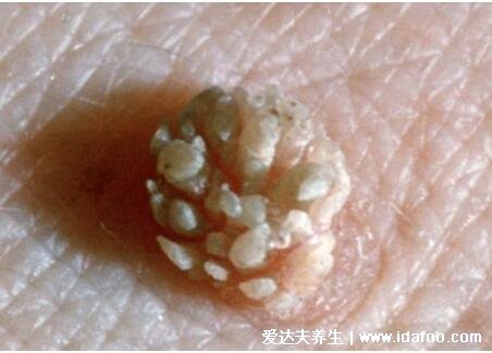 女性假疣和真疣的区别图片，看看尖湿锐尤典型图片(真疣可X接触传染)