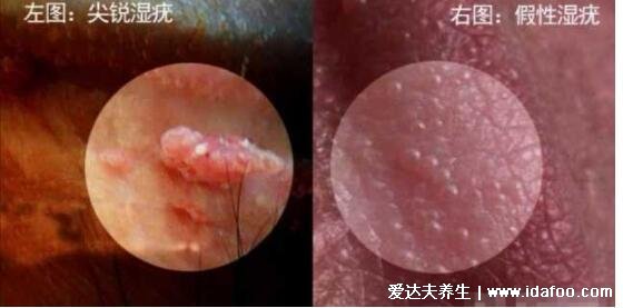 女性假疣和真疣的区别图片，看看尖湿锐尤典型图片(真疣可X接触传染)