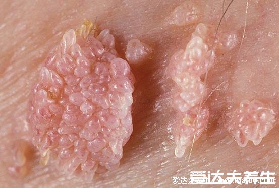 女性假疣和真疣的区别图片，看看尖湿锐尤典型图片(真疣可X接触传染)