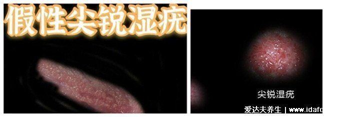 女性假疣和真疣的区别图片，看看尖湿锐尤典型图片(真疣可X接触传染)