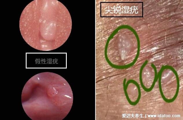 女性假疣和真疣的区别图片，看看尖湿锐尤典型图片(真疣可X接触传染)