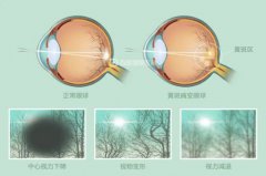 视网膜黄斑病变如何消除(如何预防新冠病